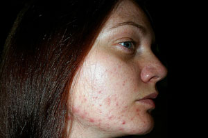 Imagen ilustrativa del artículo Consejos para rostros con acné