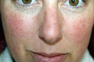 Imagen ilustrativa del artículo Cómo tratar y cuidar un rostro con rosácea